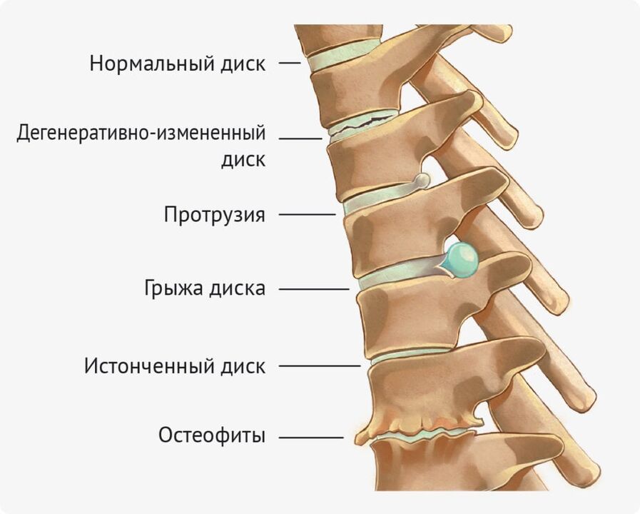 Disk defects for lumbar osteochondrosis
