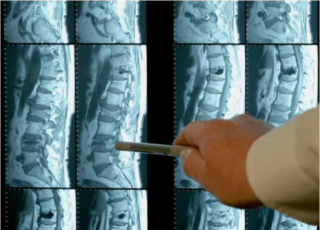 A variety of osteochondrosis in the spine
