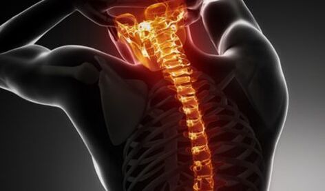 Osteochondrosis of the rest of the spine