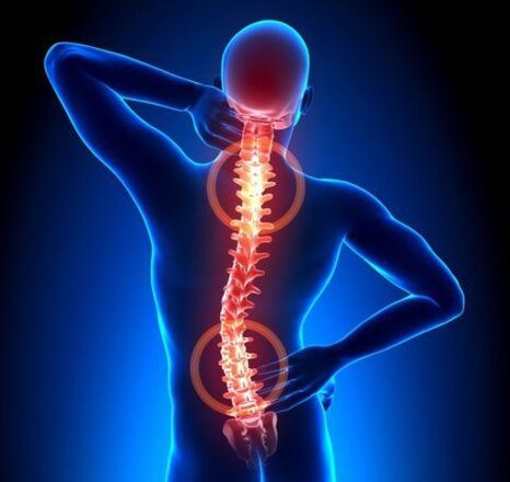 Spinal osteochondrosis