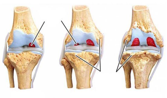 degrees-arthrosis