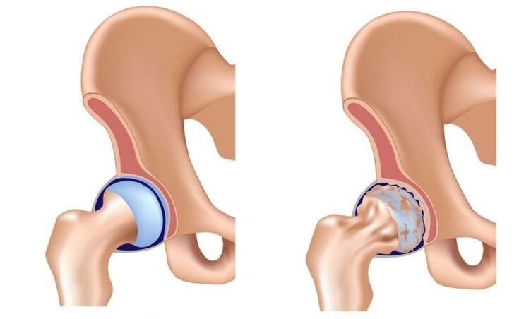 Healthy and together with arthrosis
