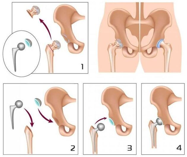 Replacing pain joints with prosthesis