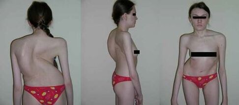 spinal curvature due to osteochondrosis