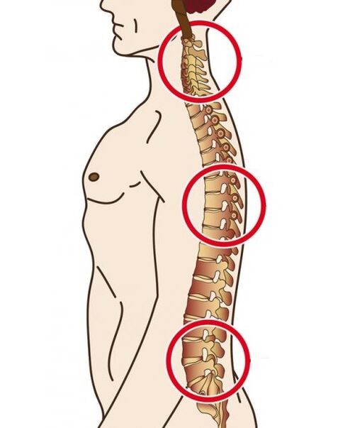 spinal department where osteochondrosis occurs