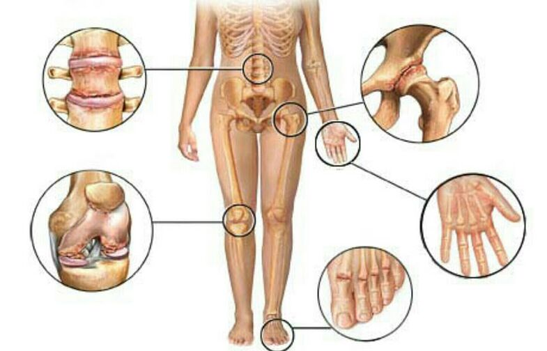 type and degree of arthrosis