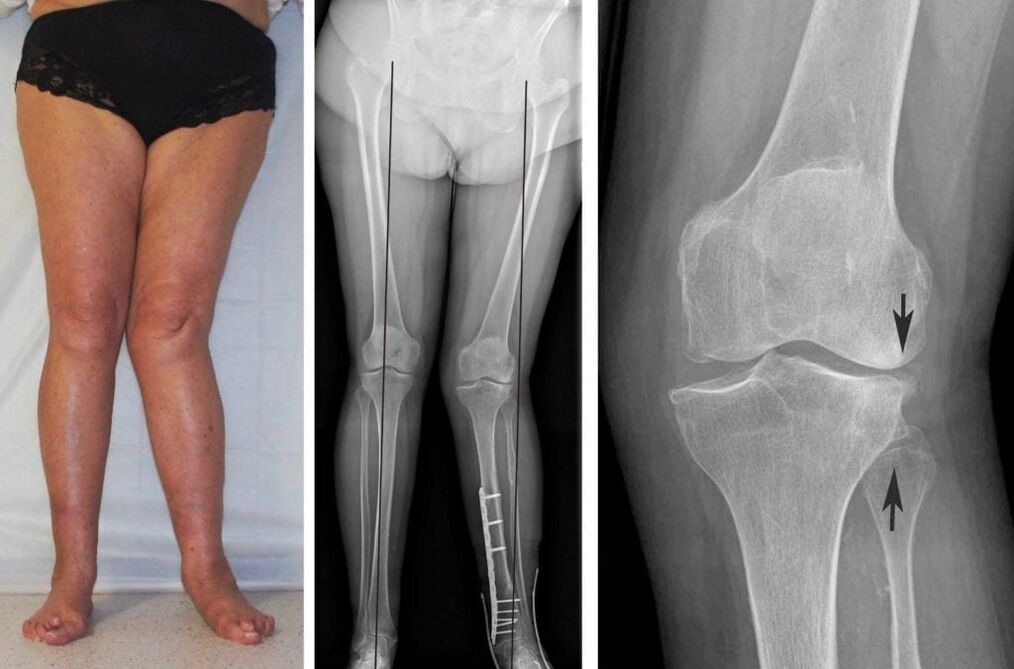 Advanced arthrosis of the knee joint is clearly visible visually even without an x-ray