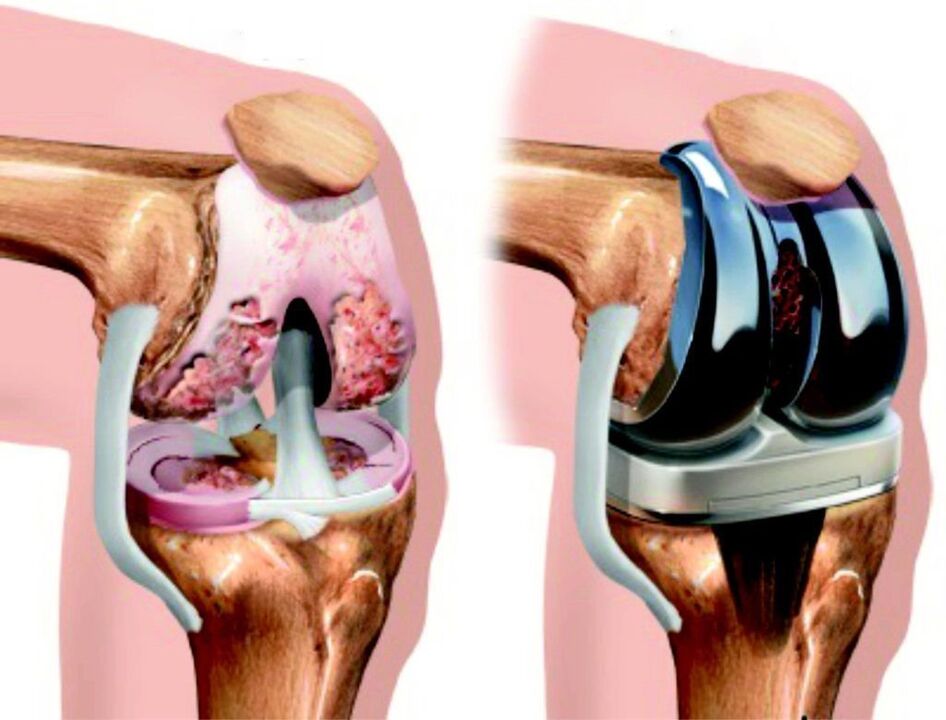 In case of total damage to the knee joint by arthrosis, it can be restored with endoprosthetics