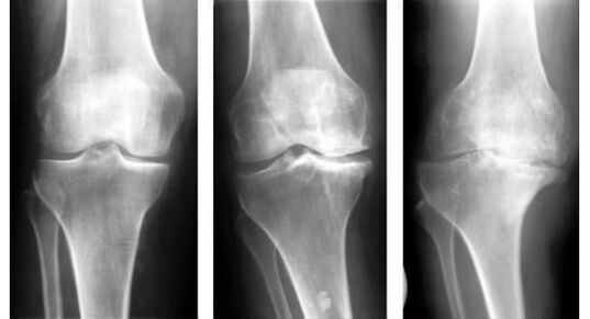 The mandatory diagnostic step when identifying knee arthrosis is an x-ray